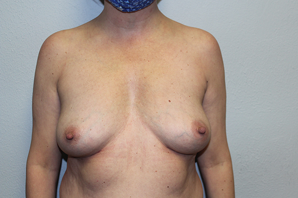 Before and after plastic surgery results in Dallas, TX, performed by Dr. Surjit Rai, MD.