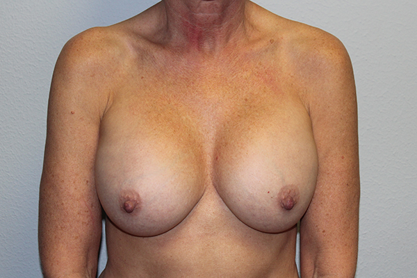 Before and after plastic surgery results in Dallas, TX, performed by Dr. Surjit Rai, MD.
