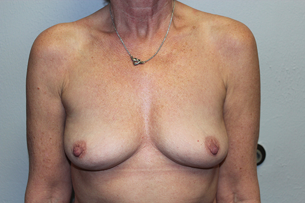 Before and after plastic surgery results in Dallas, TX, performed by Dr. Surjit Rai, MD.