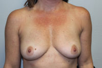 Breast Explant