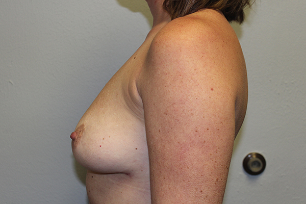 Before and after plastic surgery results in Dallas, TX, performed by Dr. Surjit Rai, MD.