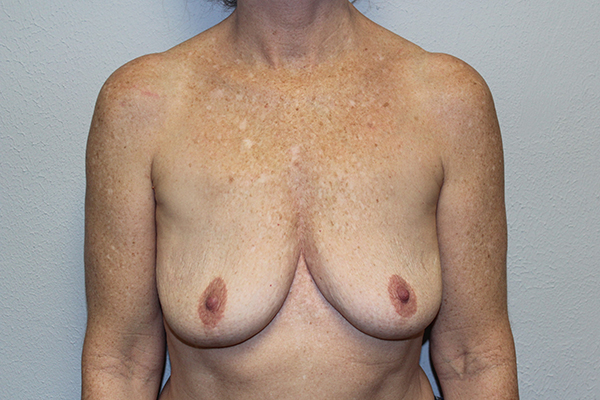 Before and after plastic surgery results in Dallas, TX, performed by Dr. Surjit Rai, MD.