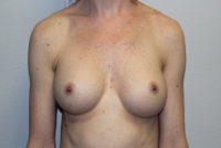 Breast Explant