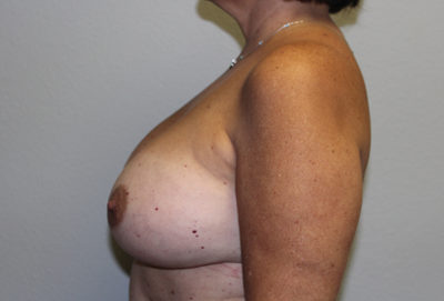 Before & After Photos: Breast Explant with Lift or Reduction