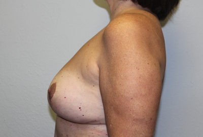 Before & After Photos: Breast Explant with Lift or Reduction