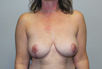 Before & After Photos: Breast Explant with Lift or Reduction