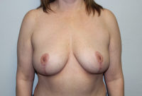 Breast Explant with Lift or Reduction