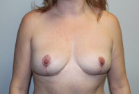 Breast Explant with Lift or Reduction