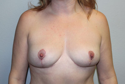 Breast Explant with Lift or Reduction