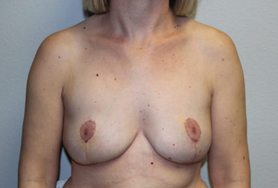 Breast Explant with Lift or Reduction