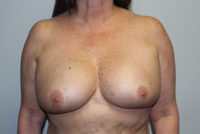 Breast Explant