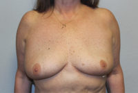 Breast Explant