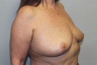 Breast Explant