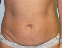Before & After Photos: Breast Explant With Other Cosmetic Procedures