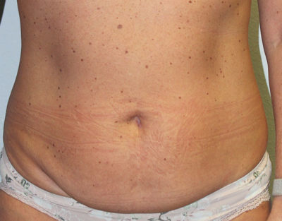 Before & After Photos: Breast Explant With Other Cosmetic Procedures
