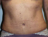 Breast Explant With Other Cosmetic Procedures