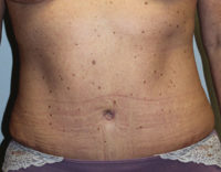 Before & After Photos: Breast Explant With Other Cosmetic Procedures