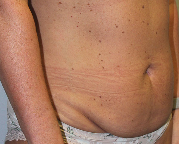 Before and after plastic surgery results in Dallas, TX, performed by Dr. Surjit Rai, MD.