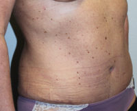 Before & After Photos: Breast Explant With Other Cosmetic Procedures