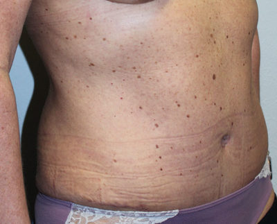 Before & After Photos: Breast Explant With Other Cosmetic Procedures