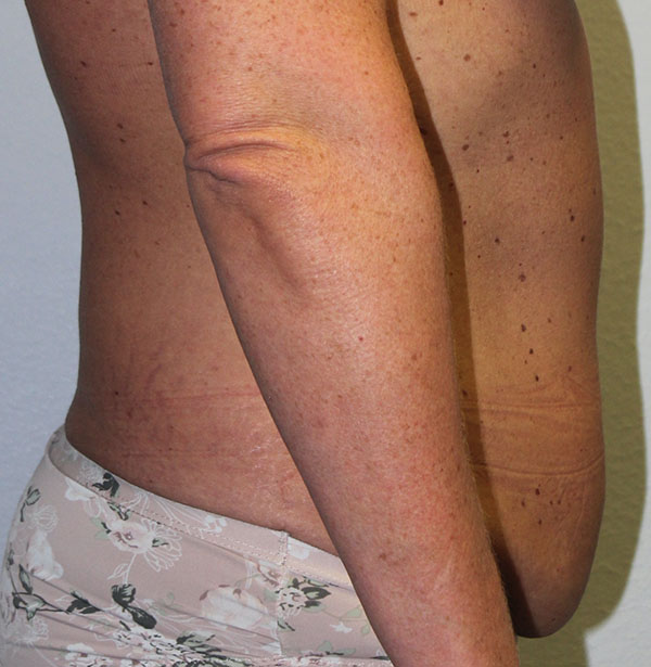 Before and after plastic surgery results in Dallas, TX, performed by Dr. Surjit Rai, MD.