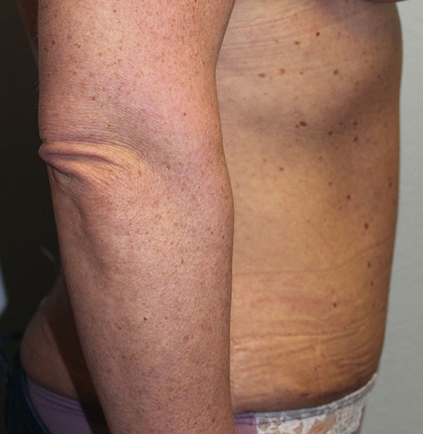 Before and after plastic surgery results in Dallas, TX, performed by Dr. Surjit Rai, MD.