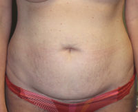Before & After Photos: Breast Explant With Other Cosmetic Procedures
