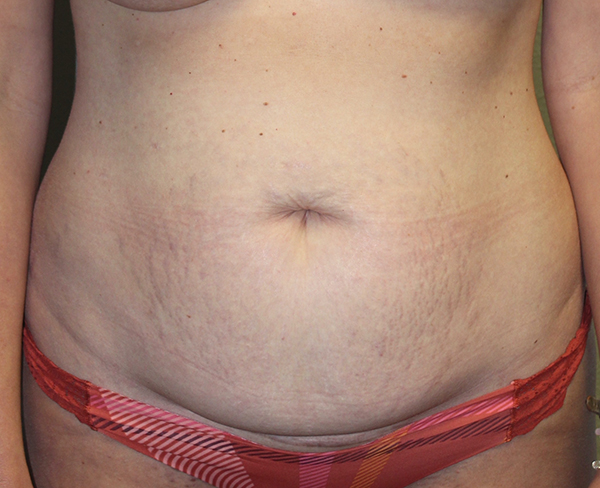 Before and after plastic surgery results in Dallas, TX, performed by Dr. Surjit Rai, MD.