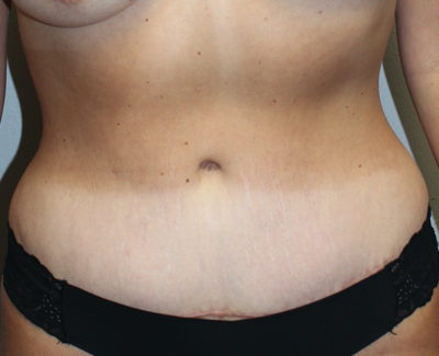 Breast Explant With Other Cosmetic Procedures