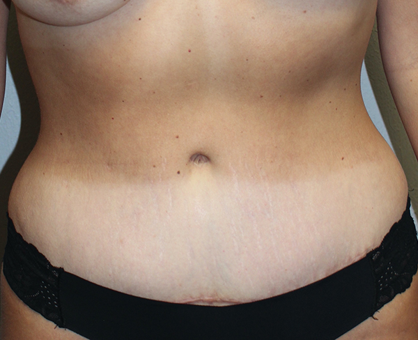 Before and after plastic surgery results in Dallas, TX, performed by Dr. Surjit Rai, MD.