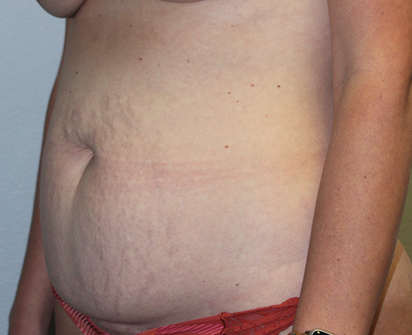 Before and after plastic surgery results in Dallas, TX, performed by Dr. Surjit Rai, MD.