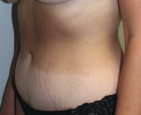 Before and after plastic surgery results in Dallas, TX, performed by Dr. Surjit Rai, MD.