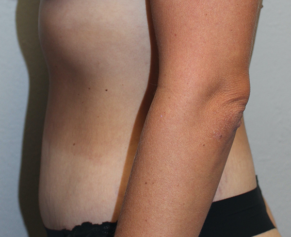 Before and after plastic surgery results in Dallas, TX, performed by Dr. Surjit Rai, MD.