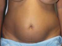 Before & After Photos: Breast Explant With Other Cosmetic Procedures