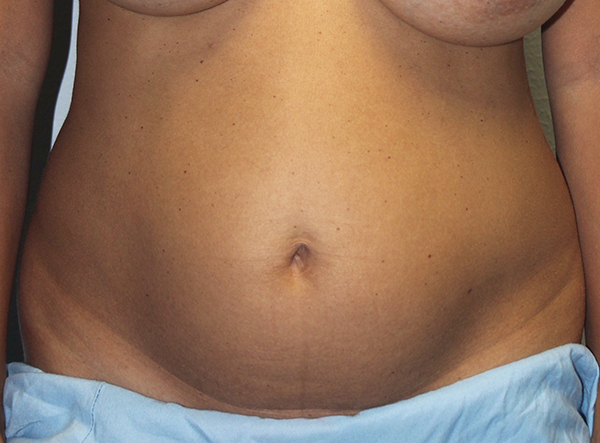 Before and after plastic surgery results in Dallas, TX, performed by Dr. Surjit Rai, MD.