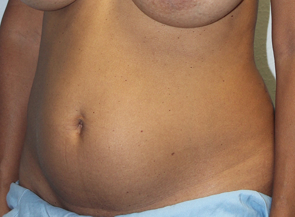 Before and after plastic surgery results in Dallas, TX, performed by Dr. Surjit Rai, MD.