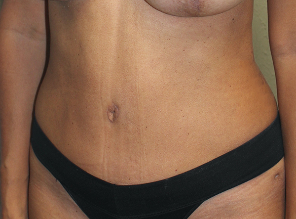 Before and after plastic surgery results in Dallas, TX, performed by Dr. Surjit Rai, MD.