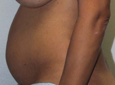 Breast Explant With Other Cosmetic Procedures