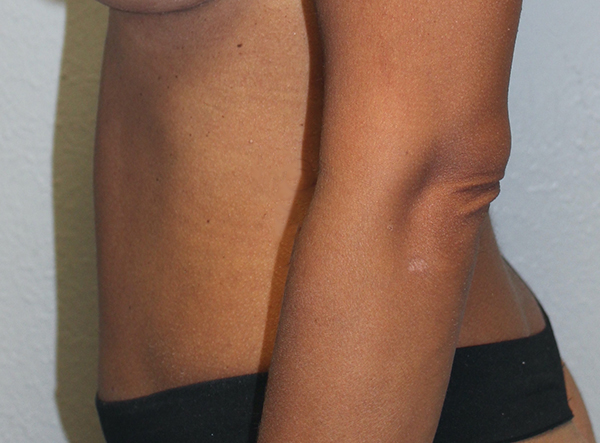 Before and after plastic surgery results in Dallas, TX, performed by Dr. Surjit Rai, MD.