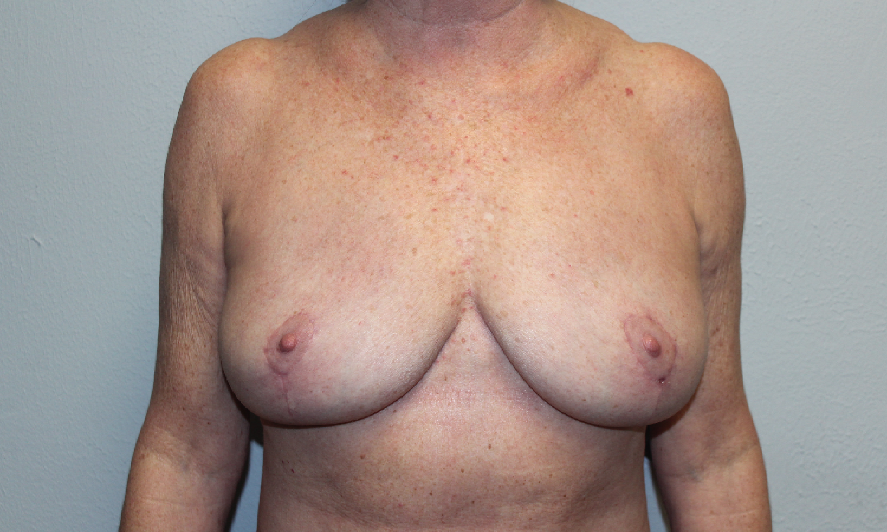 Before and after plastic surgery results in Dallas, TX, performed by Dr. Surjit Rai, MD.