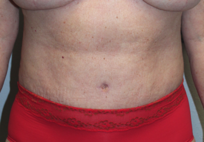 Before & After Photos: Breast Explant With Other Cosmetic Procedures