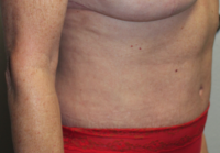 Before & After Photos: Breast Explant With Other Cosmetic Procedures