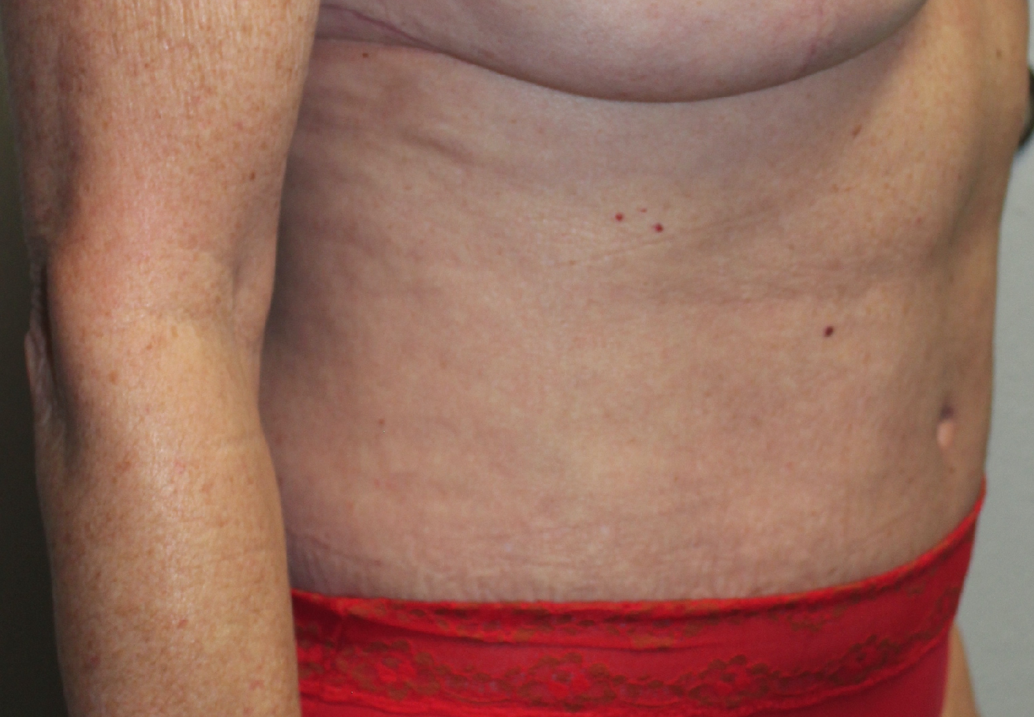 Before and after plastic surgery results in Dallas, TX, performed by Dr. Surjit Rai, MD.