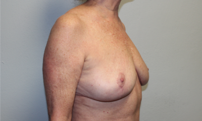 Breast Explant with Lift or Reduction