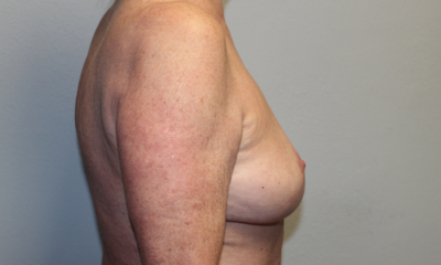 Breast Explant with Lift or Reduction