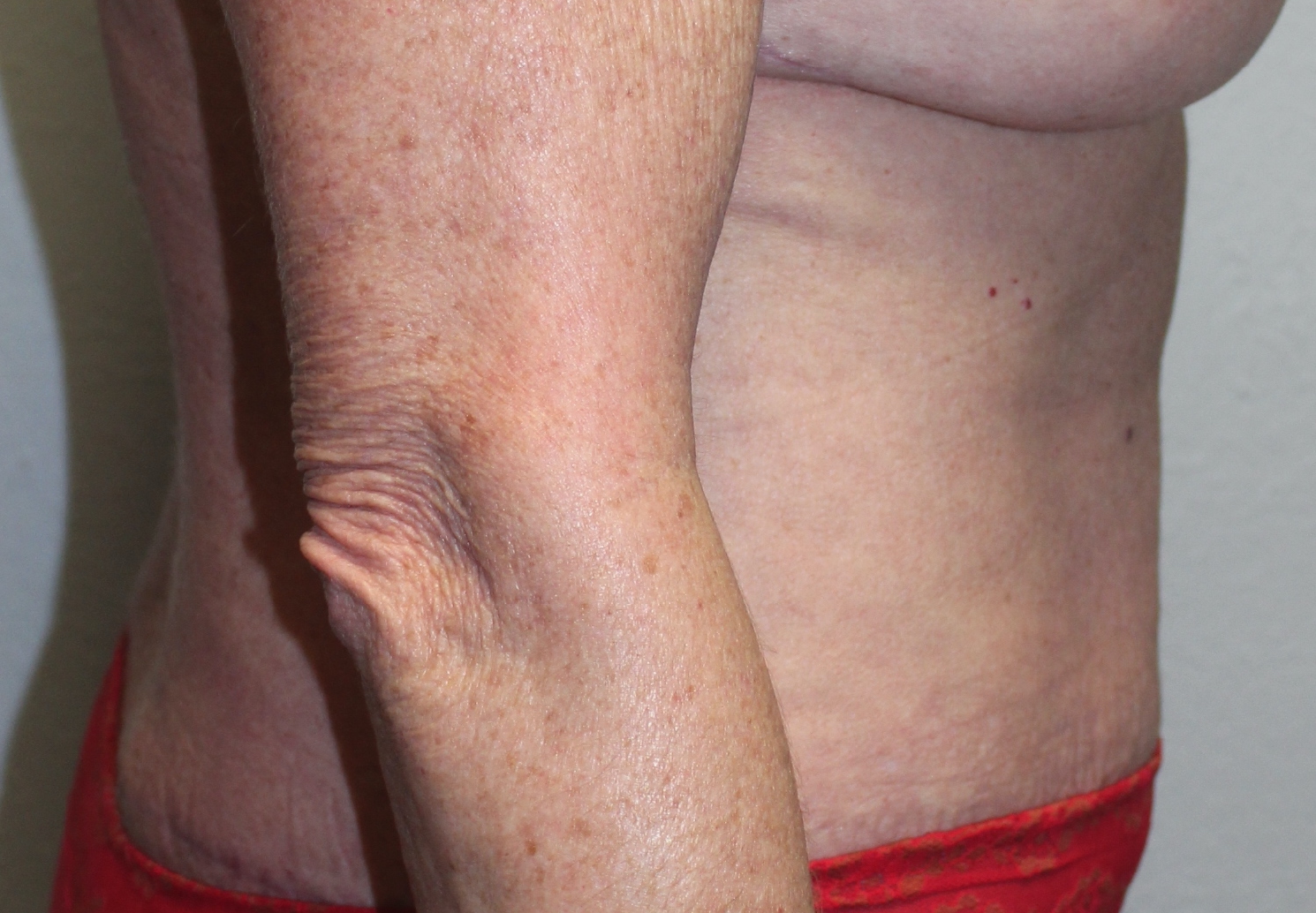 Before and after plastic surgery results in Dallas, TX, performed by Dr. Surjit Rai, MD.