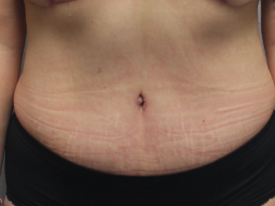 Before & After Photos: Breast Explant With Other Cosmetic Procedures