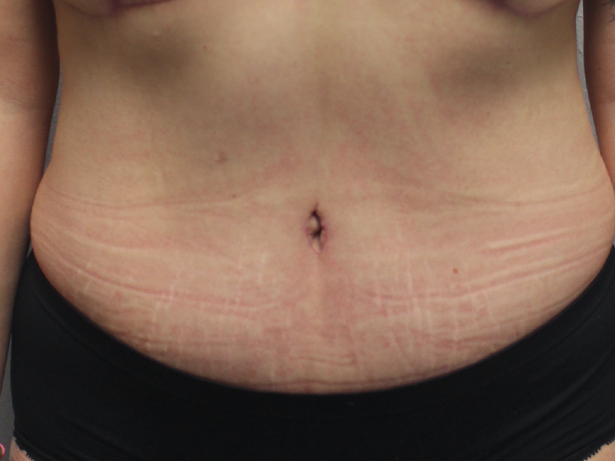 Before and after plastic surgery results in Dallas, TX, performed by Dr. Surjit Rai, MD.