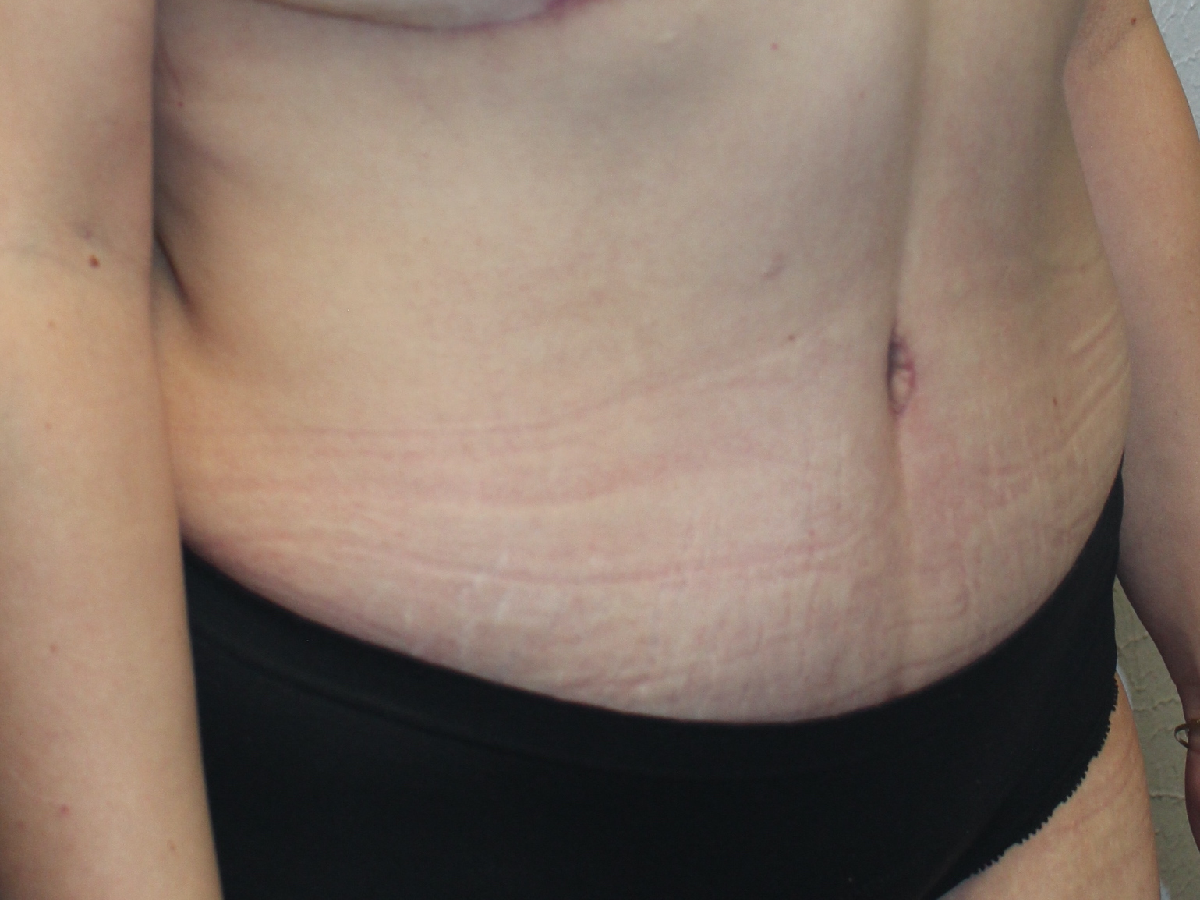 Before and after plastic surgery results in Dallas, TX, performed by Dr. Surjit Rai, MD.