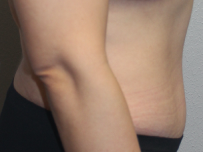 Before & After Photos: Breast Explant With Other Cosmetic Procedures